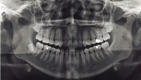 Radiografía panorámica de terceros molares