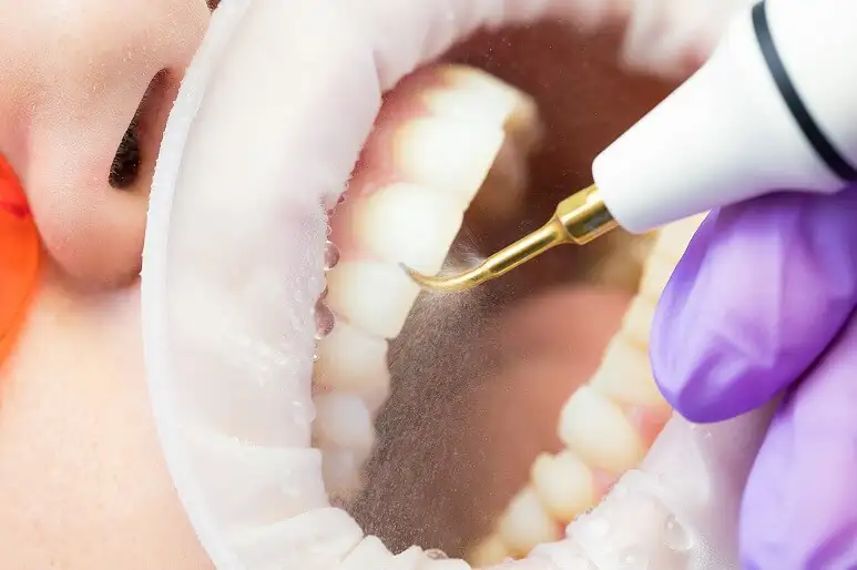 Limpieza dental realizada con ultrasonido