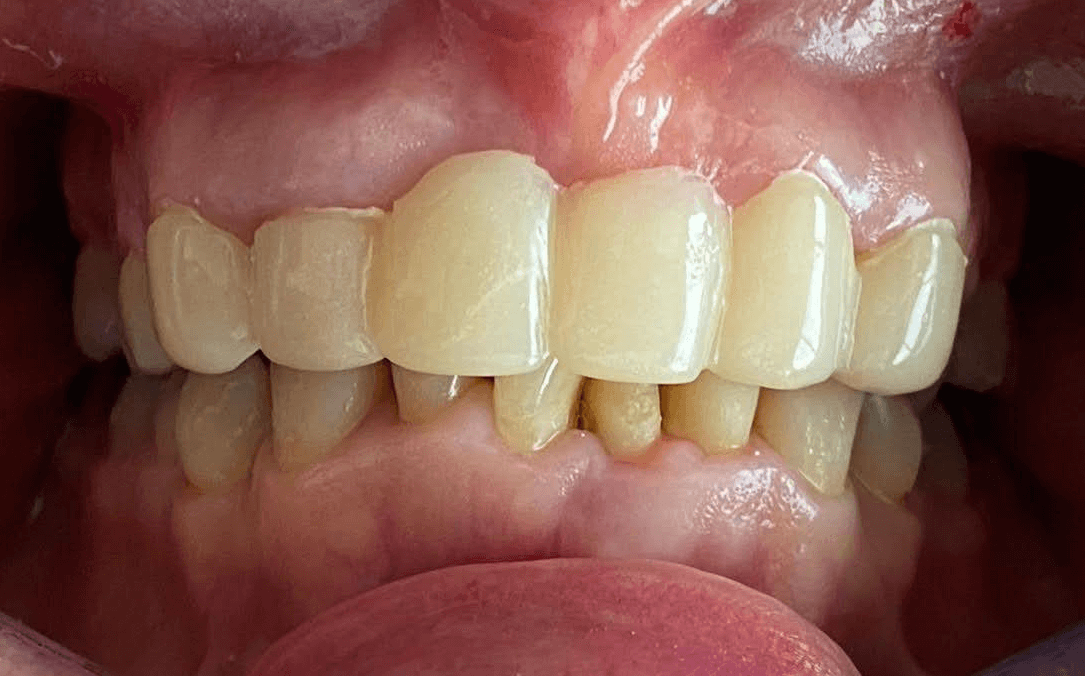 foto de protesis dental provisional