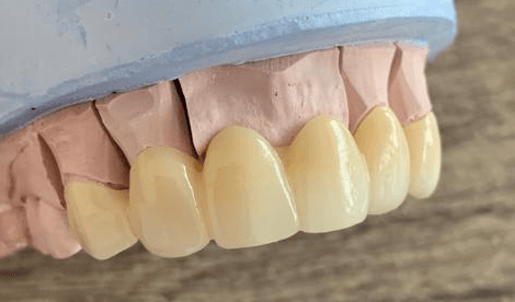 foto de protesis dental en zirconio