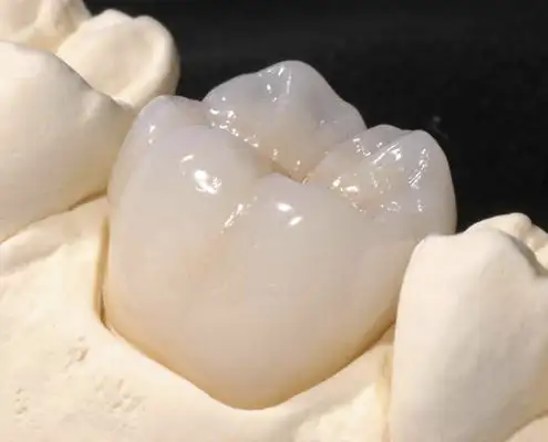 Corona dental de zirconio en primer molar
