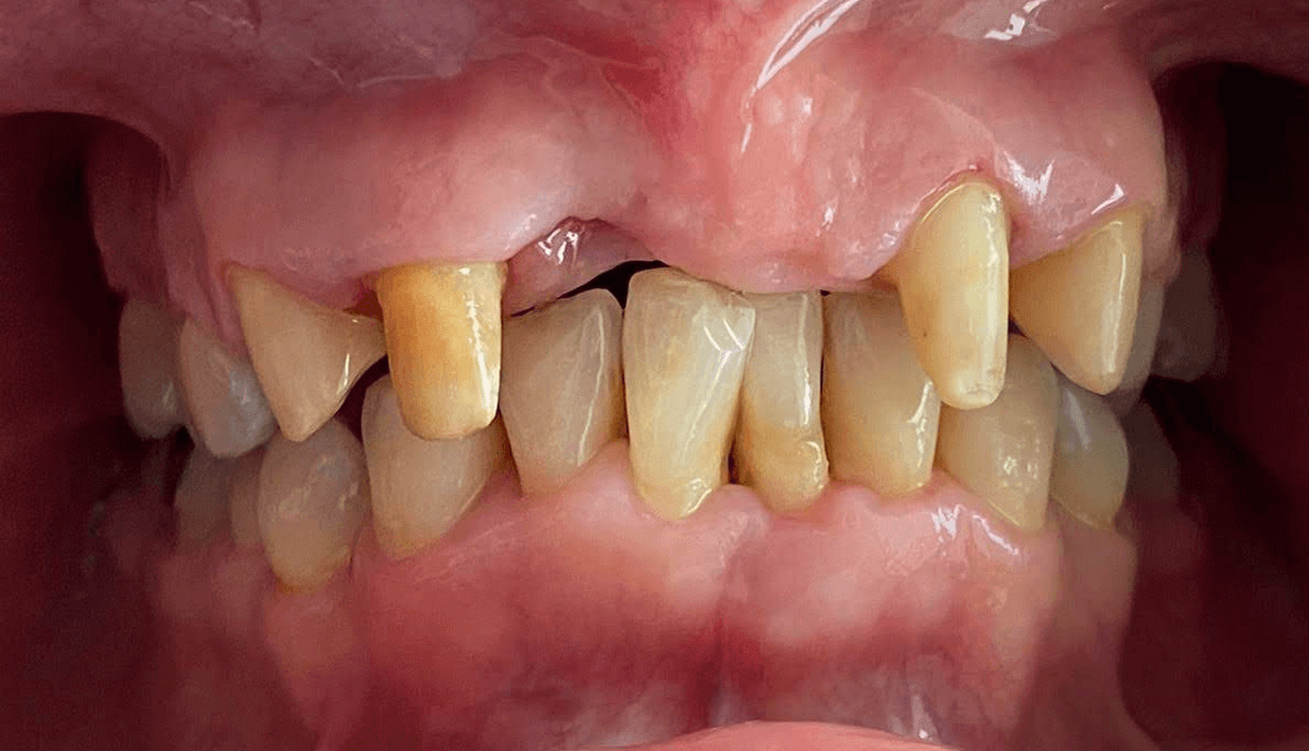 foto de paciente sin protesis dental